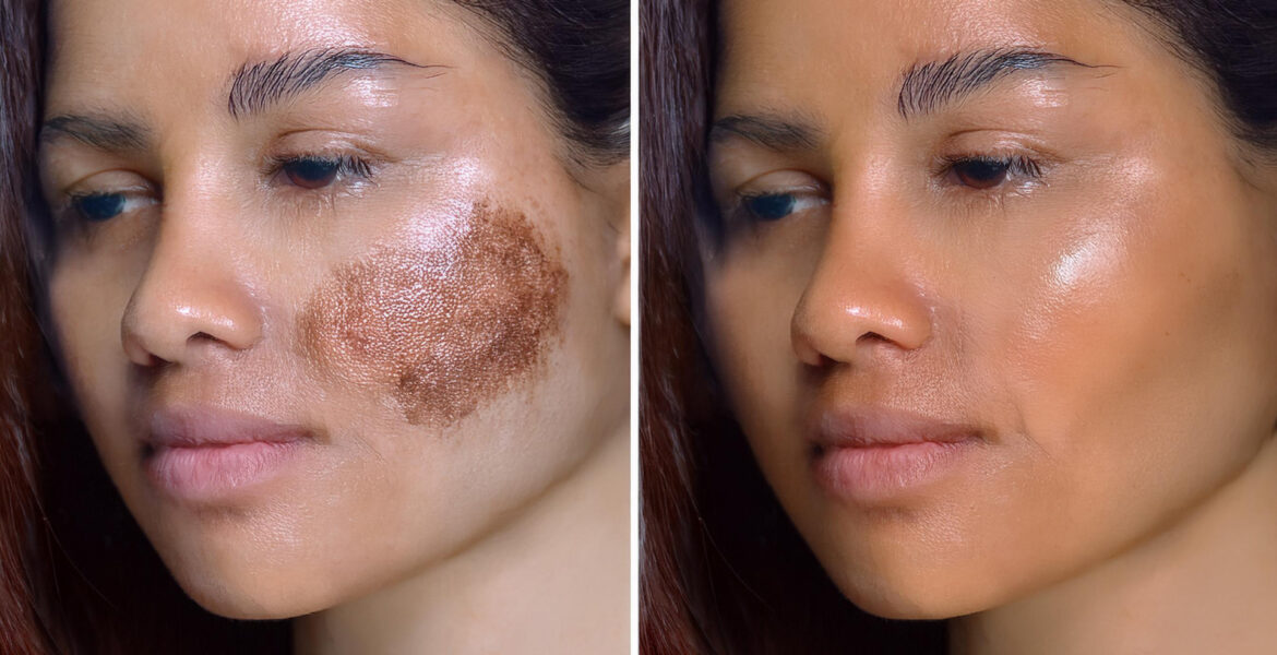 pigmentation before after