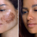 pigmentation before after