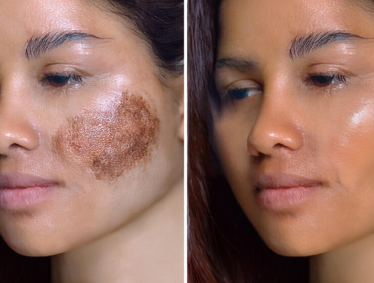 pigmentation before after