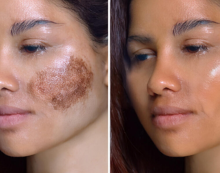 pigmentation before after