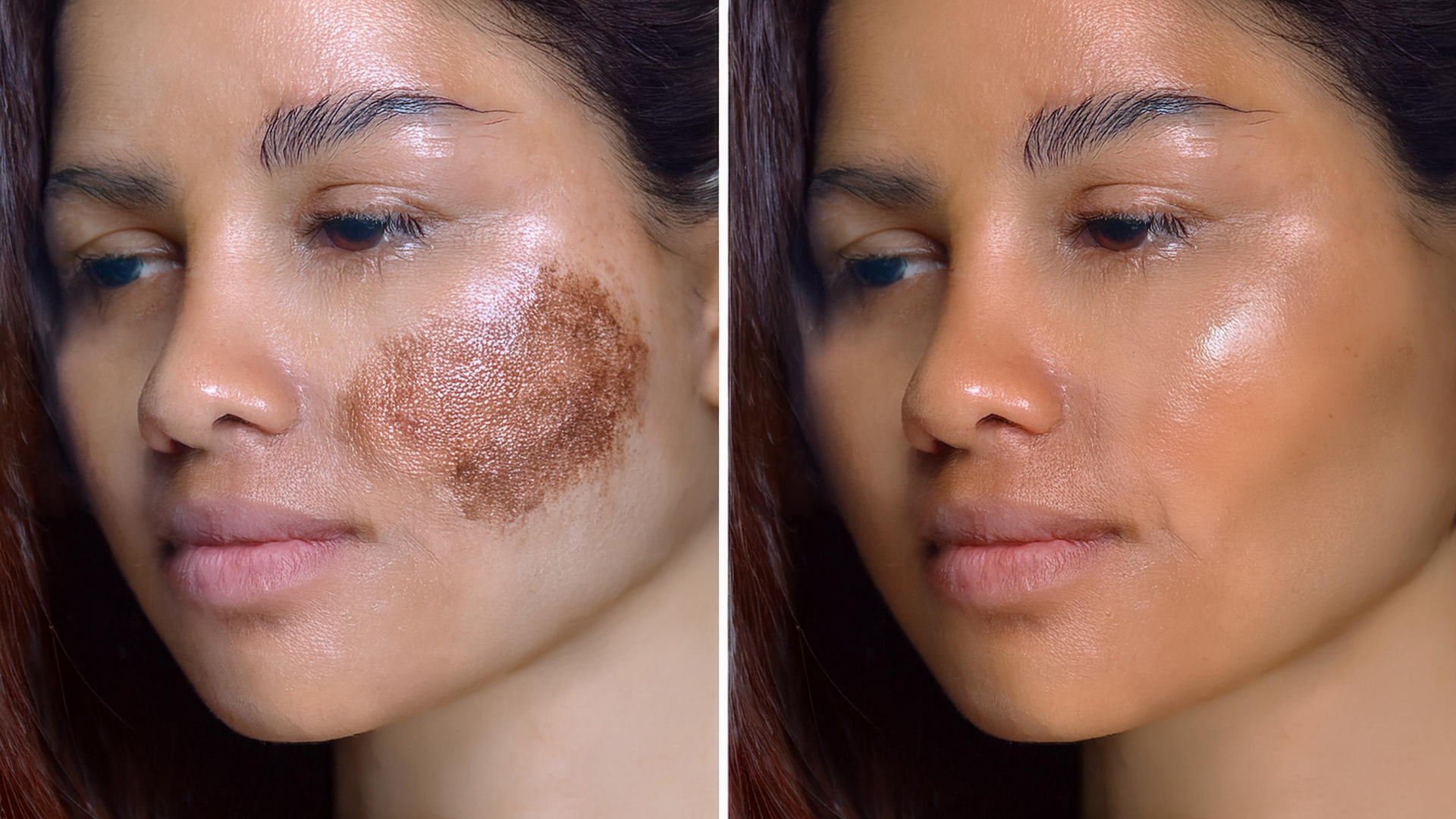 pigmentation before after